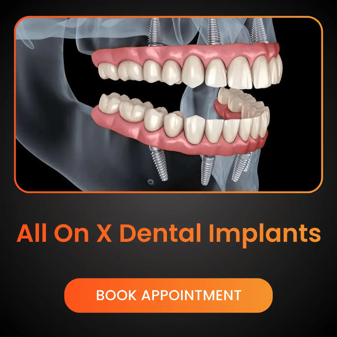 All On X Dental Implants
