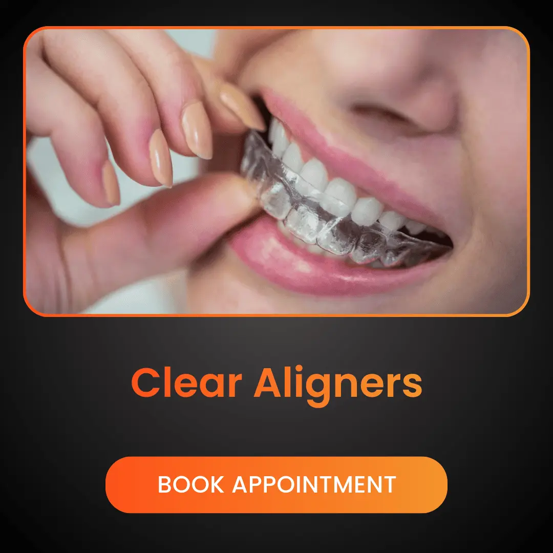 Clear Aligners