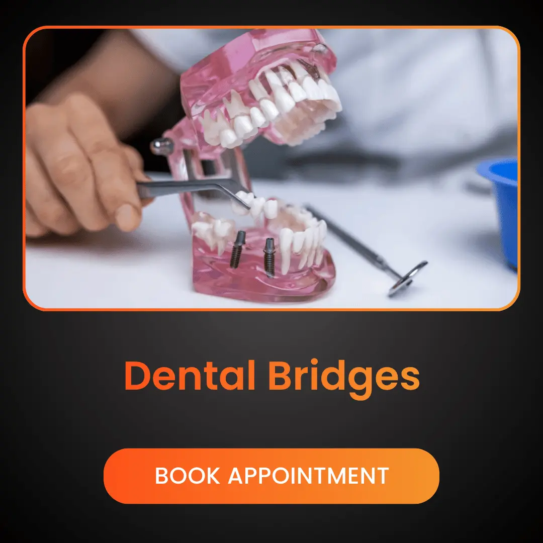 Dental Bridges