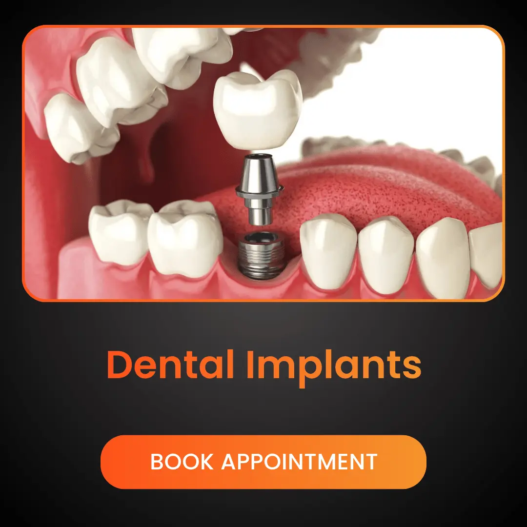 Dental Implants