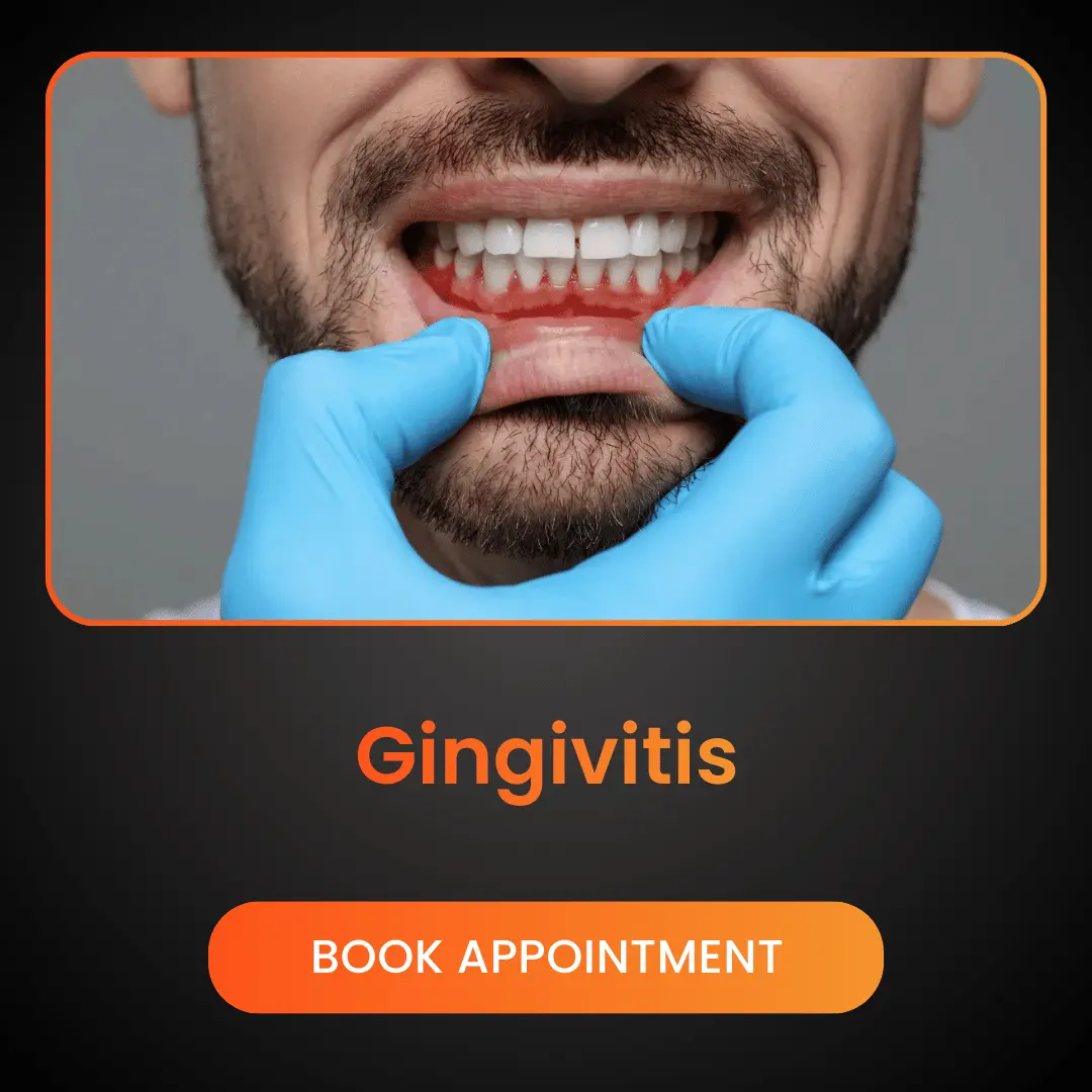 Gingivitis (1)