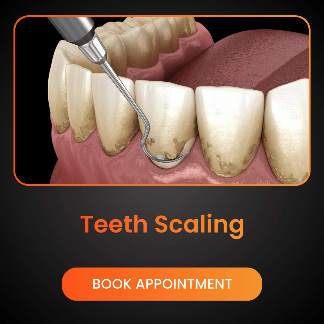 Teeth Scaling