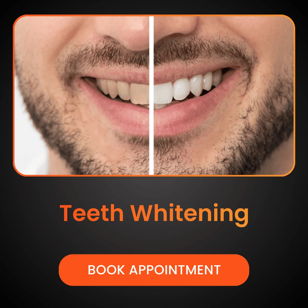 Teeth Whitening (1)