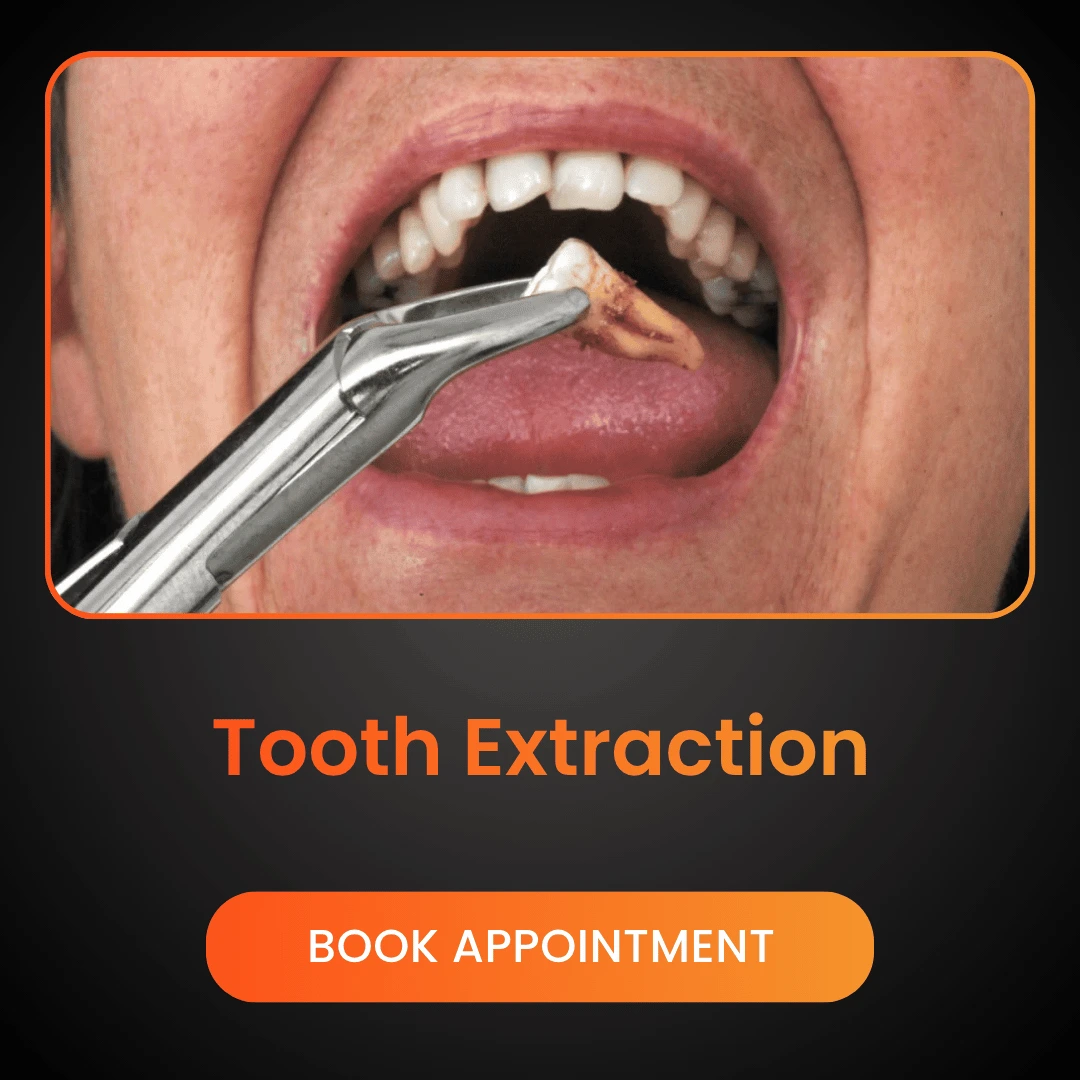 Tooth Extraction